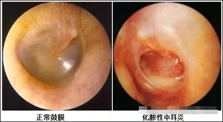 产生耳鸣后要看清鼓膜再议