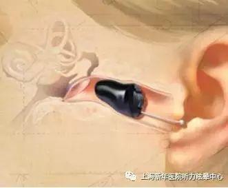 助听器知识