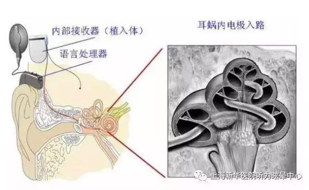 助听器知识