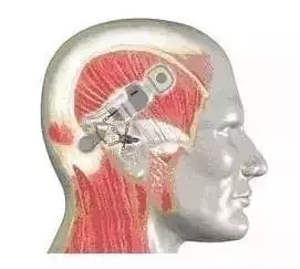 助听器黑科技——完全植入式助听器